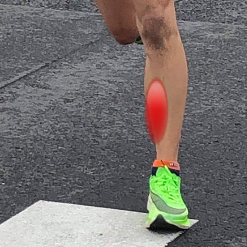 シンスプリント | 鳥取整体院