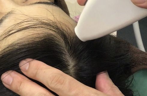 女性の薄毛治療