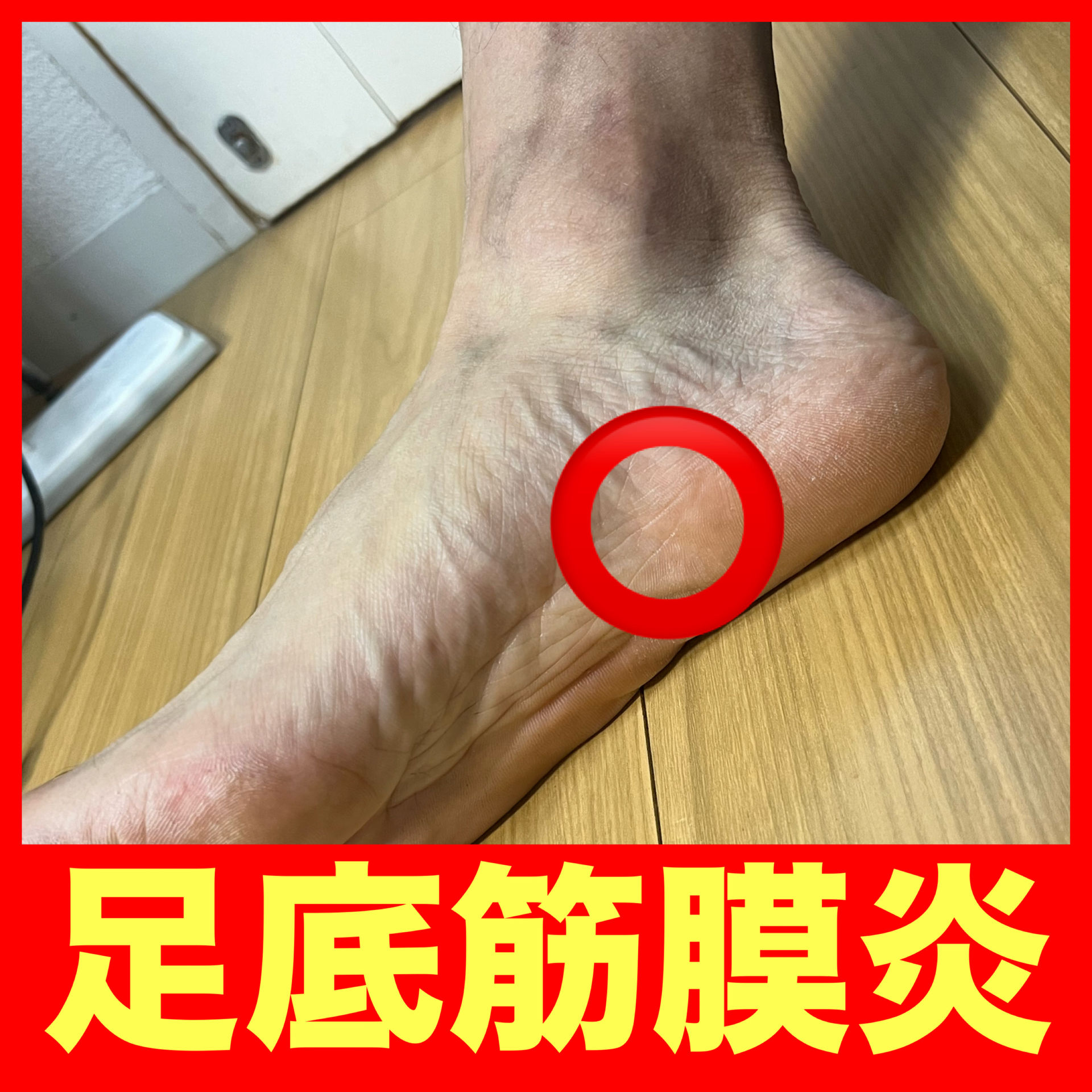足底筋膜炎